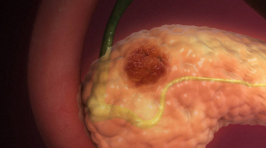 Scientists Found Treatment for Deadly Pancreatic Cancer. Image Courtesy: scientificanimations 